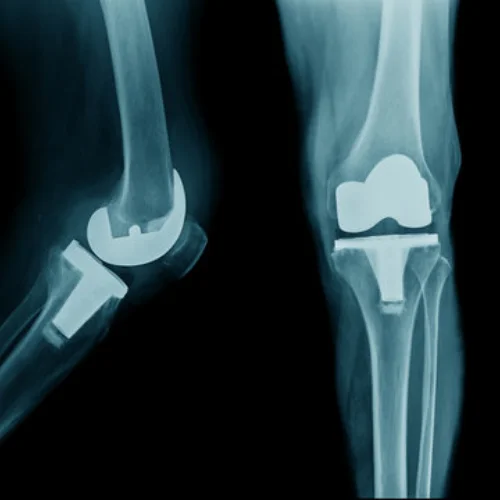 Arthroplasty 1
