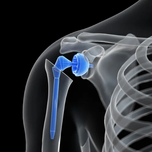 Arthroscopy Image 3