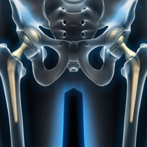 Arthroplasty 3