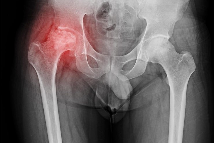 Hip Avascular Necrosis