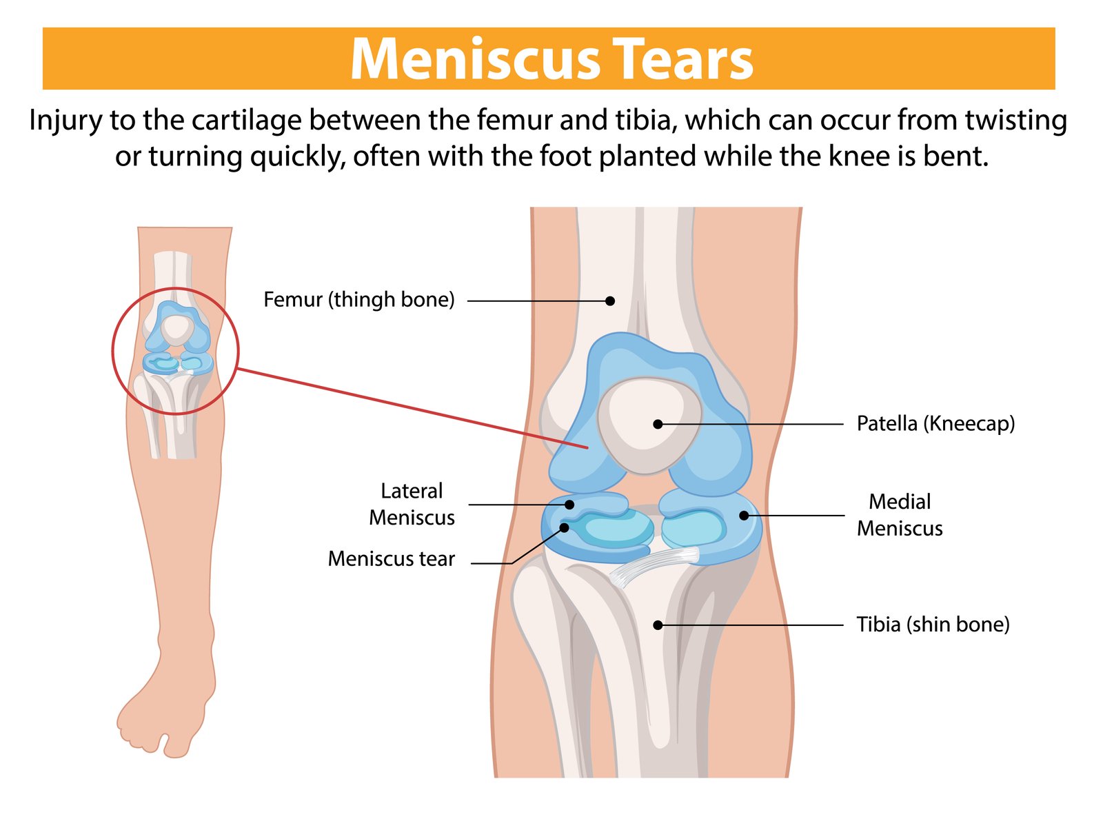 Meniscus Repair Surgery