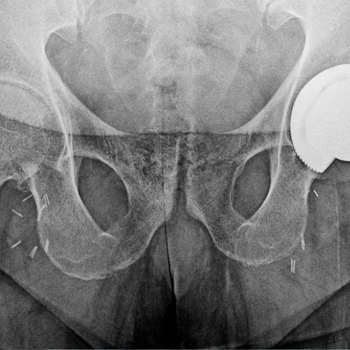 Hip AVN 2
