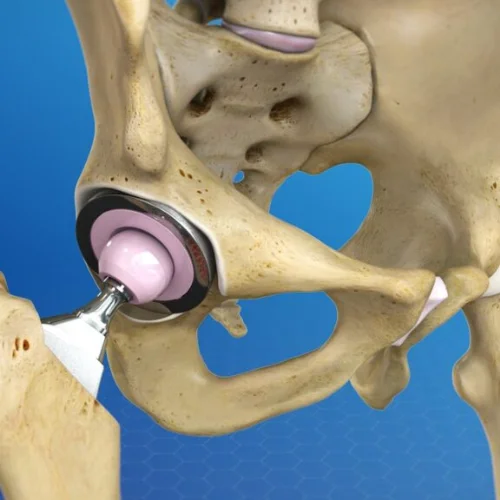 Hip Replacement