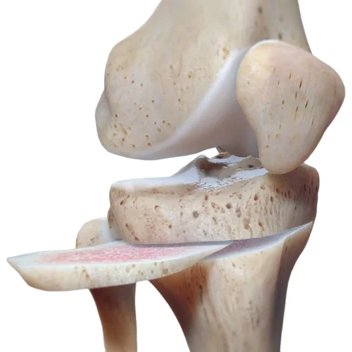 Knee Osteotomy 1