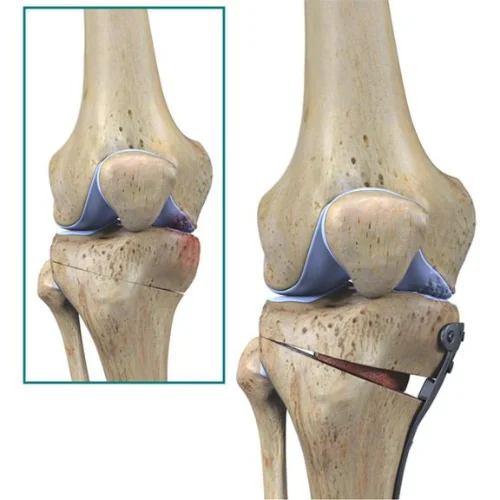Knee Osteotomy 2