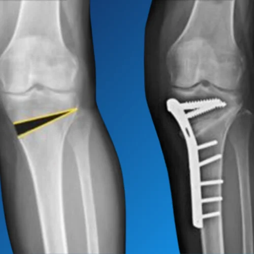 Knee Osteotomy 3