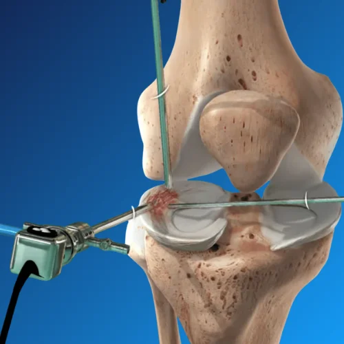 Meniscus Repair Surgery