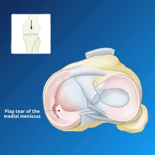 Meniscus Surgery Recovery