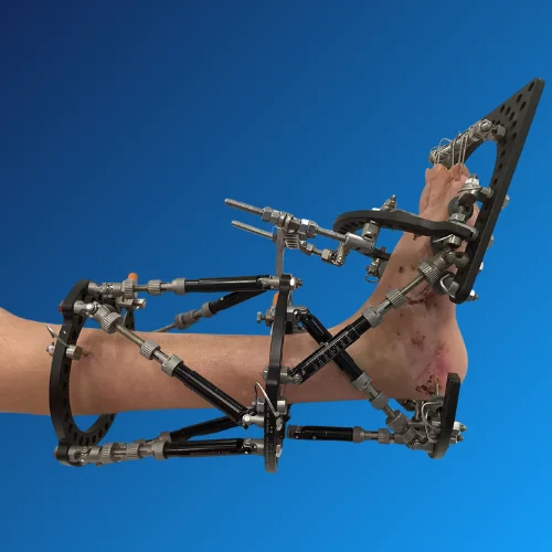 Orthopaedic Deformity Correction