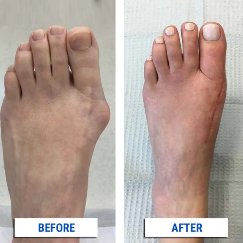 Limb Alignment Surgery