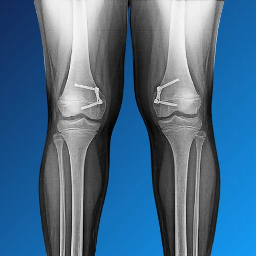 Post Surgery Rehabilitation